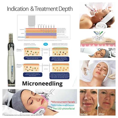 5mm and 1. . Difference between 16 and 36 needle microneedling